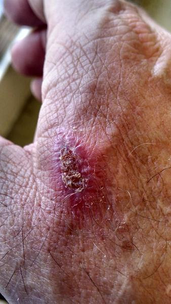 morgellons non healing lesions, non healing lesions, unsightly Morgellons lesions,